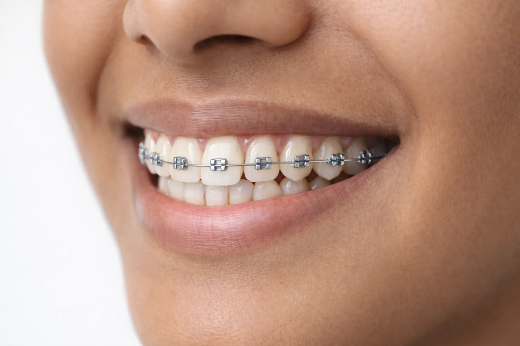 Braces Before and After